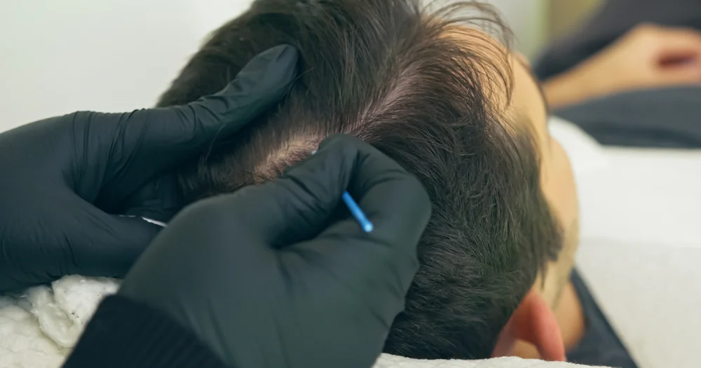 Scalp Micropigmentation