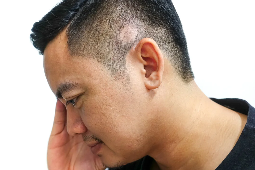 Scarringalopecia