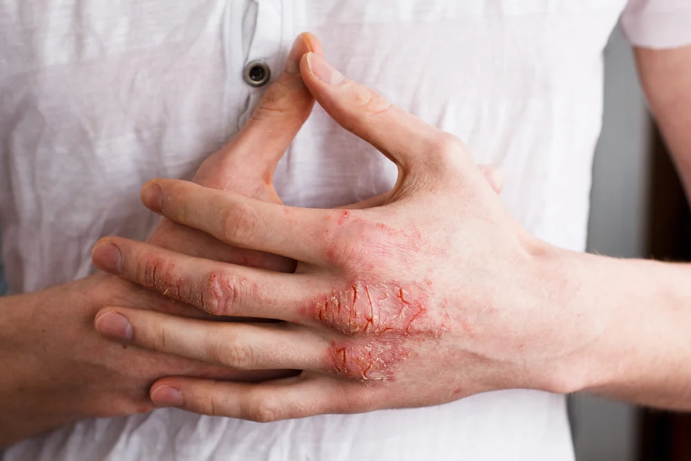 eczema