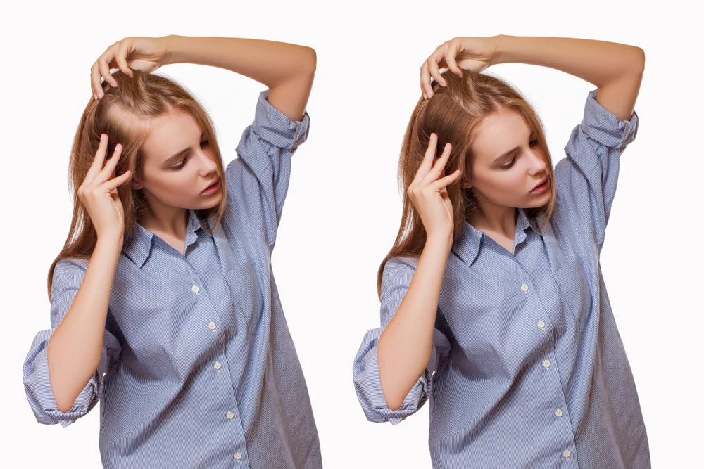female-hair-tranplant