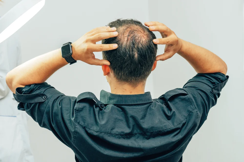 male-pattern-baldness