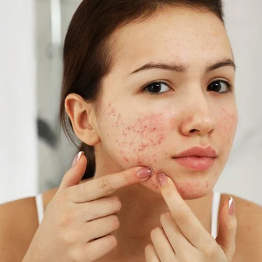 acne-treatment-varanasi